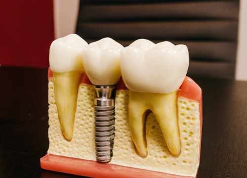 Nécessité d'une greffe osseuse pour vos implants dentaires