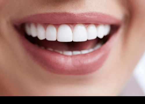 Facette dentaire en Turquie pour embellir votre sourire et le rendre éclatant. 