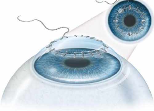 Greffe de la cornée en Turquie pour retrouver une vue parfaite.