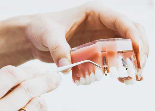 Pose d'implant dentaire