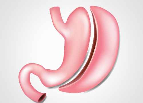 Sleeve Gastrectomie en Turquie