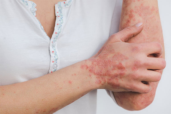 Traitements du Psoriasis