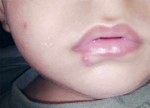 Virus de l'herpès labial simplex chez les enfants