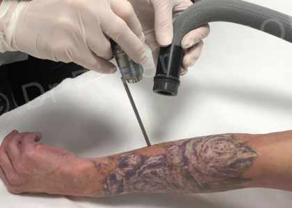 Detatouage laser au cabinet du Dr Dubois à Angers