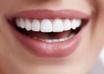 Facette dentaire en Turquie pour embellir votre sourire et le rendre éclatant. 