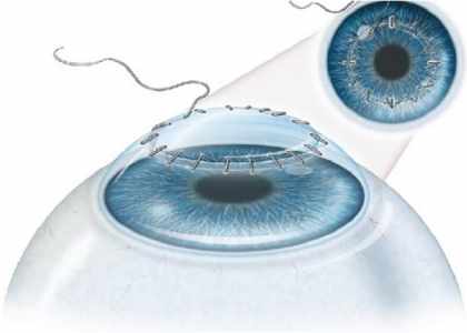 Greffe de la cornée en Turquie pour retrouver une vue parfaite.