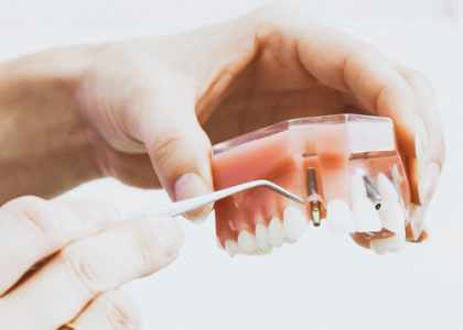 Pose d'implant dentaire